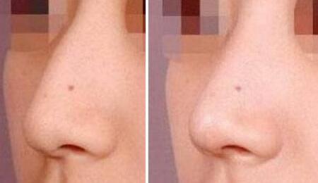 駝峰鼻矯正前后對比圖，鼻子整形圖片