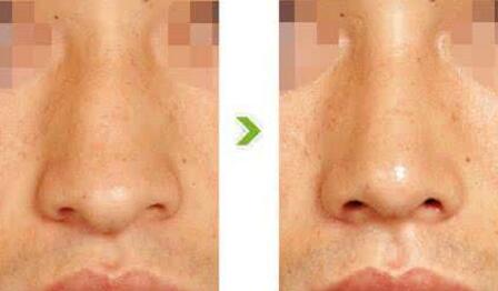 鷹鉤鼻整形前后對比圖