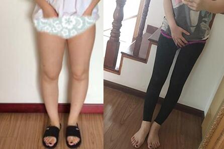 北京大腿吸脂減肥多少錢？哪家整形醫(yī)院好？正規(guī)醫(yī)院推薦