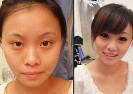 眼袋整形前后對(duì)比圖