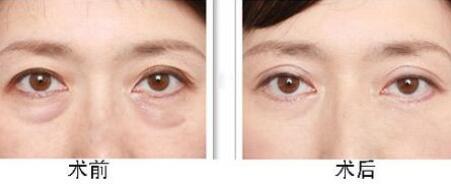 去眼袋前后對(duì)比圖圖片