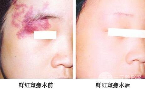 激光去胎記要多少錢?