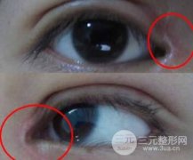 開眼角出現(xiàn)疤痕增生咋辦？