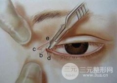 開眼角術(shù)后多久恢復(fù)？會不會留疤？