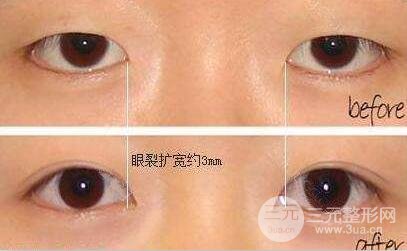 開眼角前后對比圖 開眼角后遺癥 開眼角的風(fēng)險