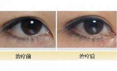 開眼角整形降低風(fēng)險嗎?