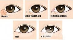 開內(nèi)眼角會使眼睛變大嗎？