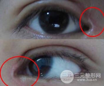 什么人不適合開內眼角？