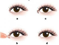 開內(nèi)眼角的危害有哪些？