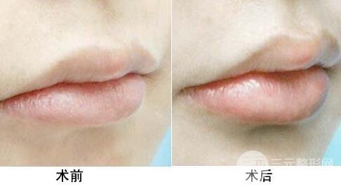 注射豐唇后有副作用嗎？