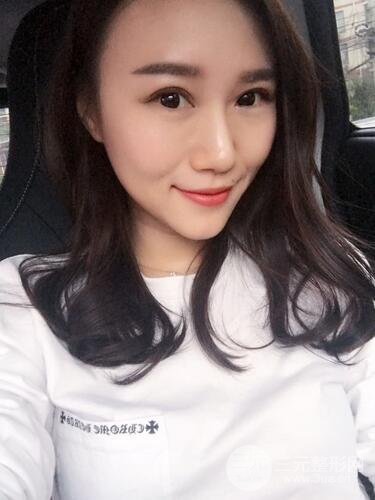 雙眼皮修復(fù)術(shù)案例圖 前后果對(duì)比--青島諾德