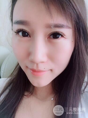 雙眼皮修復(fù)術(shù)案例圖 前后果對(duì)比--青島諾德