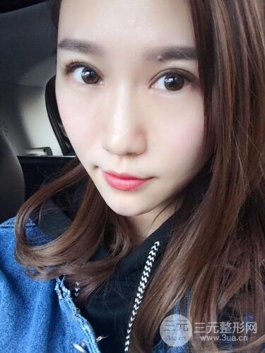 雙眼皮修復(fù)術(shù)案例圖 前后果對(duì)比--青島諾德