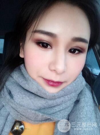 芭比雙眼皮多項整形前后對比照片 青島諾德曹繼武雙眼皮案例