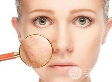 激光祛斑后會出現(xiàn)返黑是怎么回事？