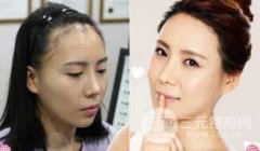 發(fā)際線種植后容易脫落嗎？