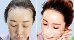 發(fā)際線種植會不會很疼呢？