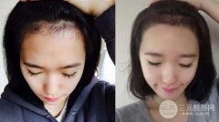 發(fā)際線種植是否容易脫落嗎？