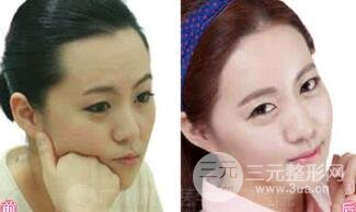 如何修飾出好看的發(fā)際線?發(fā)際線脫毛要注意哪些事項(xiàng)?