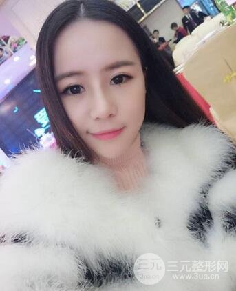 假體隆鼻恢復過程實例 前后果對比