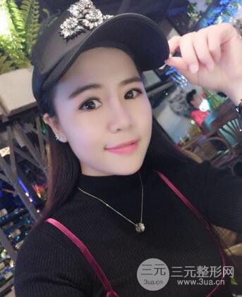 假體隆鼻恢復過程實例 前后果對比