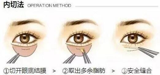 去眼袋手術(shù)果對(duì)比圖