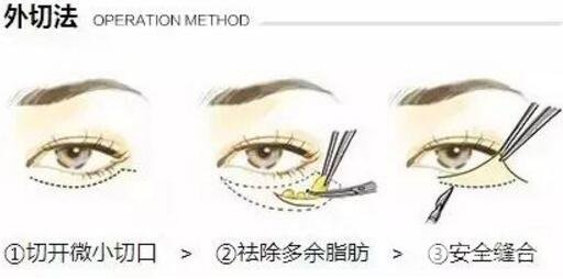 去眼袋手術(shù)果對(duì)比圖