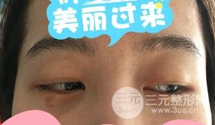 真人內(nèi)切去眼袋手術(shù)過程對比圖片和案例分享