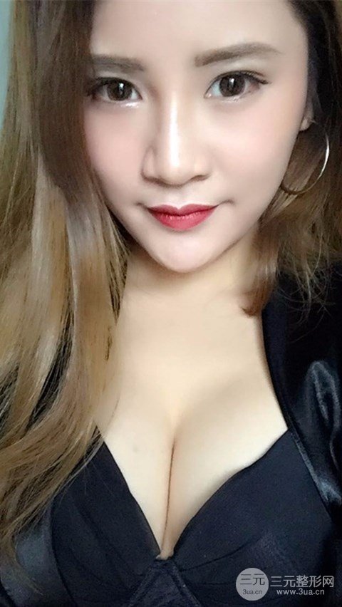 淄博陽光整形自體脂肪隆胸前后對比圖，真實案例