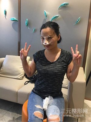 廈門思明安黛美邱健欽醫(yī)生給我做的隆鼻整形手術，大家來看看果怎么樣