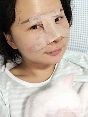 廈門思明安黛美邱健欽醫(yī)生給我做的隆鼻整形手術，大家來看看果怎么樣