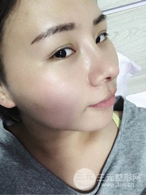 廈門思明安黛美邱健欽醫(yī)生給我做的隆鼻整形手術，大家來看看果怎么樣