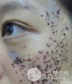 南寧緩解的太田痣真實(shí)案例,前后果對(duì)比圖