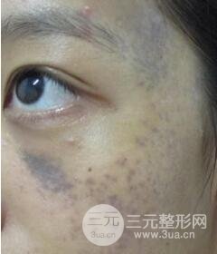 南寧緩解的太田痣真實(shí)案例,前后果對(duì)比圖