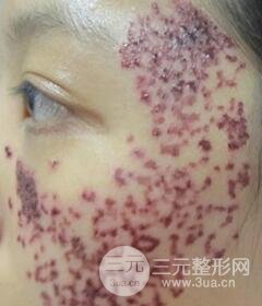 南寧緩解的太田痣真實(shí)案例,前后果對(duì)比圖