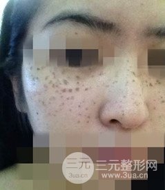 激光祛斑的恢復(fù)過程，逐步見證自己顏值的逐步提升。