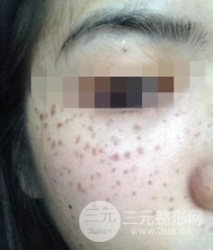 激光祛斑的恢復(fù)過程，逐步見證自己顏值的逐步提升。