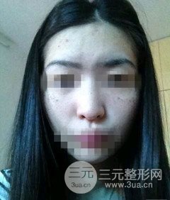 激光祛斑的恢復(fù)過程，逐步見證自己顏值的逐步提升。