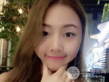 開內(nèi)眼角和三點(diǎn)定位雙眼皮恢復(fù)過程圖片真人案例分享