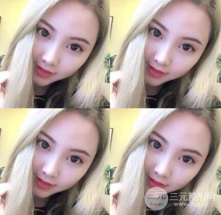 開內(nèi)眼角和三點(diǎn)定位雙眼皮恢復(fù)過程圖片真人案例分享