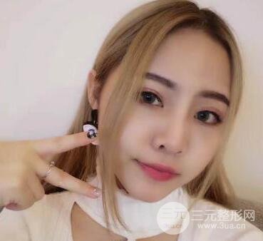 開內(nèi)眼角和三點(diǎn)定位雙眼皮恢復(fù)過程圖片真人案例分享