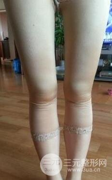 全身吸脂減肥前后對(duì)比圖和恢復(fù)過程真實(shí)案例分享