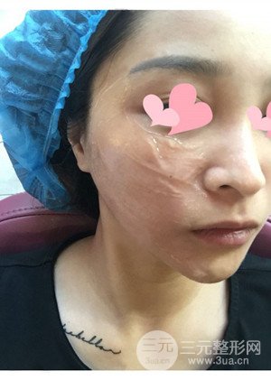 高強(qiáng)度聚焦超聲手術(shù)前后過程以及真實(shí)案例分享——廈門思明安黛美林韻醫(yī)生做的