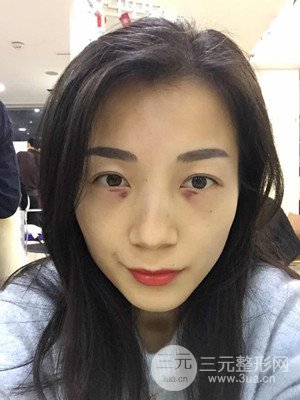 分享我的激光祛眼袋手術(shù)前后過程，廈門思明安黛美林韻醫(yī)生做的