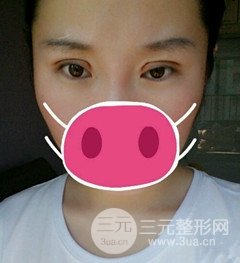 北京全切雙眼皮手術(shù)真實(shí)案例，果對(duì)比圖