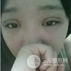 北三院三點(diǎn)定位雙眼皮整形真實(shí)案例,果對(duì)比圖