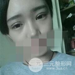 北三院三點(diǎn)定位雙眼皮整形真實(shí)案例,果對(duì)比圖