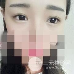 北三院三點(diǎn)定位雙眼皮整形真實(shí)案例,果對(duì)比圖