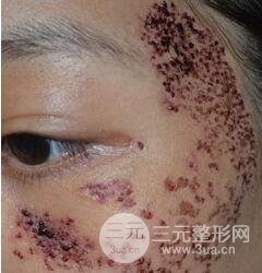 做了三次激光去太田痣，后來的果已經(jīng)是我較為滿意的了。