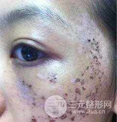 做了三次激光去太田痣，后來的果已經(jīng)是我較為滿意的了。